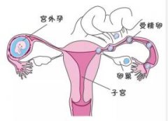 宫外孕手术后会流血吗？