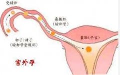 宫外孕后多久可以跳绳?